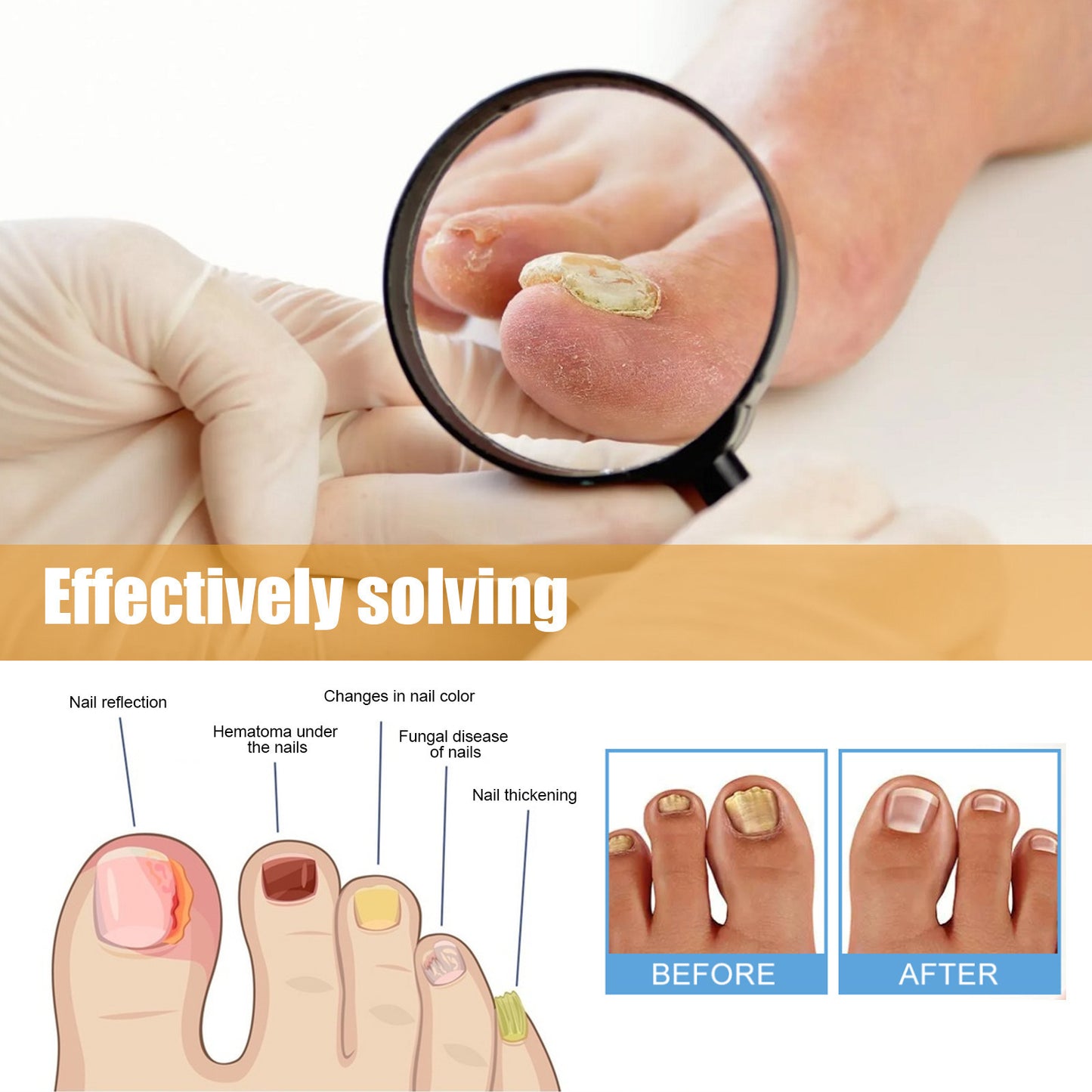 Nail Repair Patch Repair Ingrown Nail