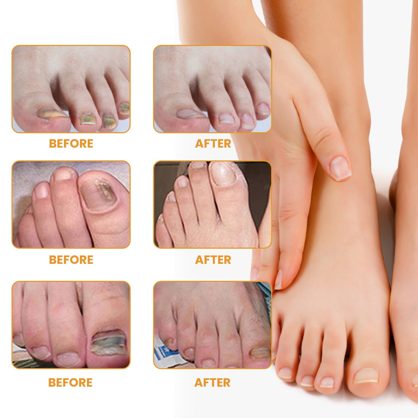 Nail Repair Patch Repair Ingrown Nail